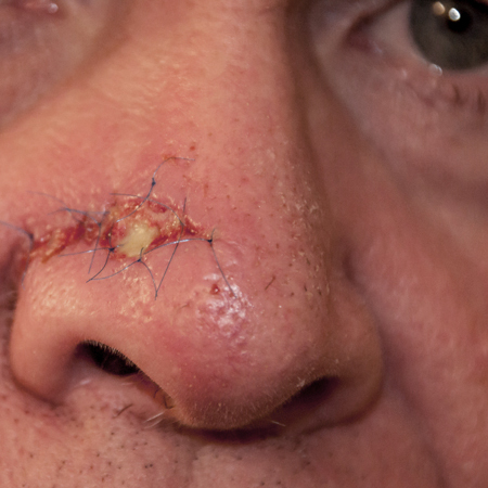 Association of Smoking and Other Factors With the Outcome of Mohs Reconstruction