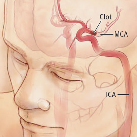 Diagnosis and Management of Transient Ischemic Attack and Acute Ischemic Stroke