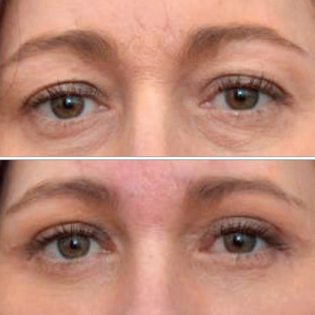 Brassiere Suture Technique in Upper Eyelid Blepharoplasty