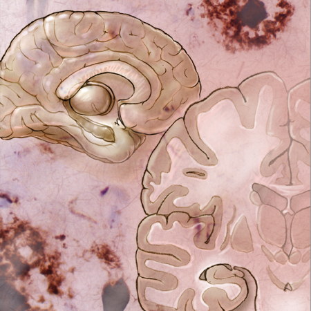 Parkinson Disease