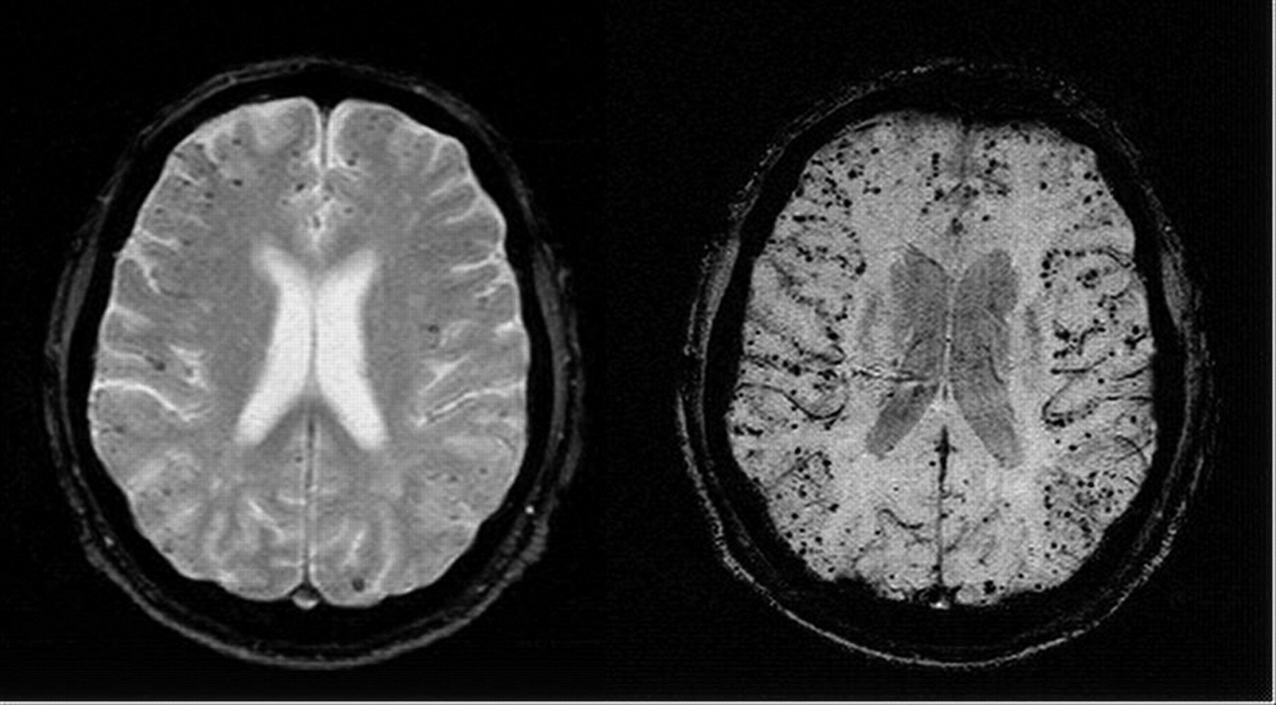 The Alzheimer's Copernicus Problem, Part 1