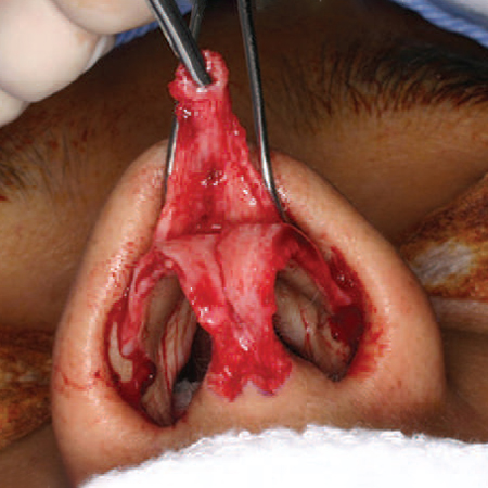 Superiorly Pediculated Superficial Musculoaponeurotic System Ligament Flap to Control the Supratip