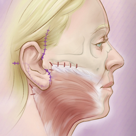 Advances in Face-lift Techniques 2013-2018