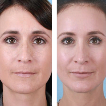 Willingness to Pay for Increased Attractiveness Through Rhinoplasty