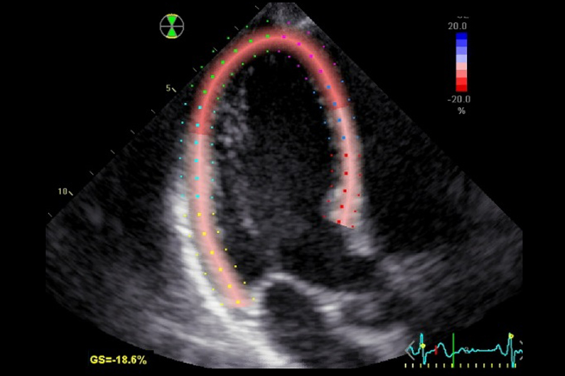 Prognostic Value of Global Longitudinal Strain for Early Prediction of Chemotherapy-Induced Cardiotoxicity