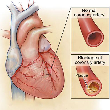 Management of Chronic Stable Angina in 2020