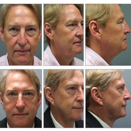 Evaluation of Personality Perception in Men Before and After Facial Cosmetic Surgery