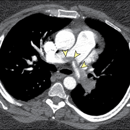 Updated Pulmonary Embolism Guidelines