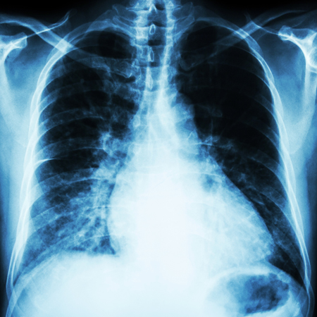 Update on Congestive Heart Failure
