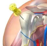 Podcast # 430: Humeral IO