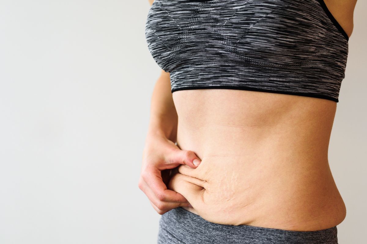 Episode 392: Q+A - How Do I Manage Excess Skin After Weight Loss?