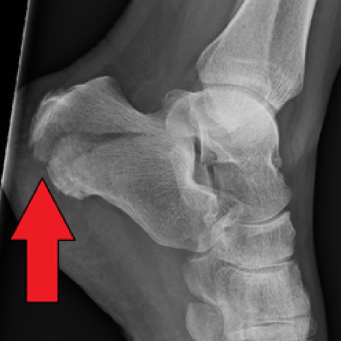 Calcaneal Fractures