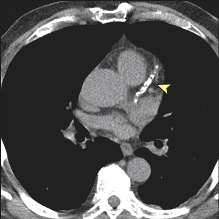 Incremental Value of a Coronary Artery Calcium Score