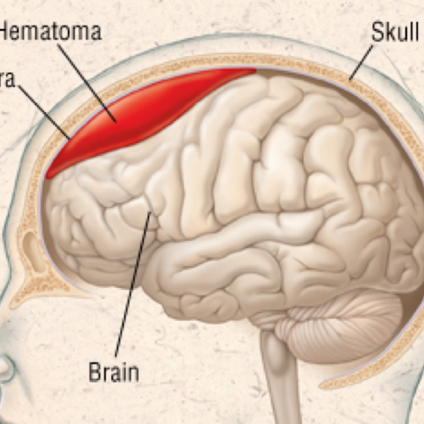 Subdural Hematoma