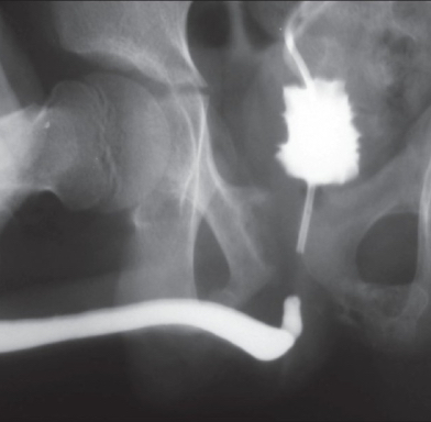 Podcast #375: Retrograde Urethrogram