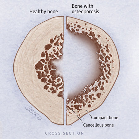 Anabolic Therapy for Osteoporosis