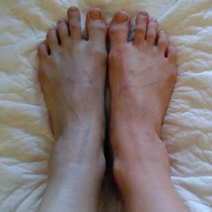 Podcast # 414: Acute Limb Ischemia