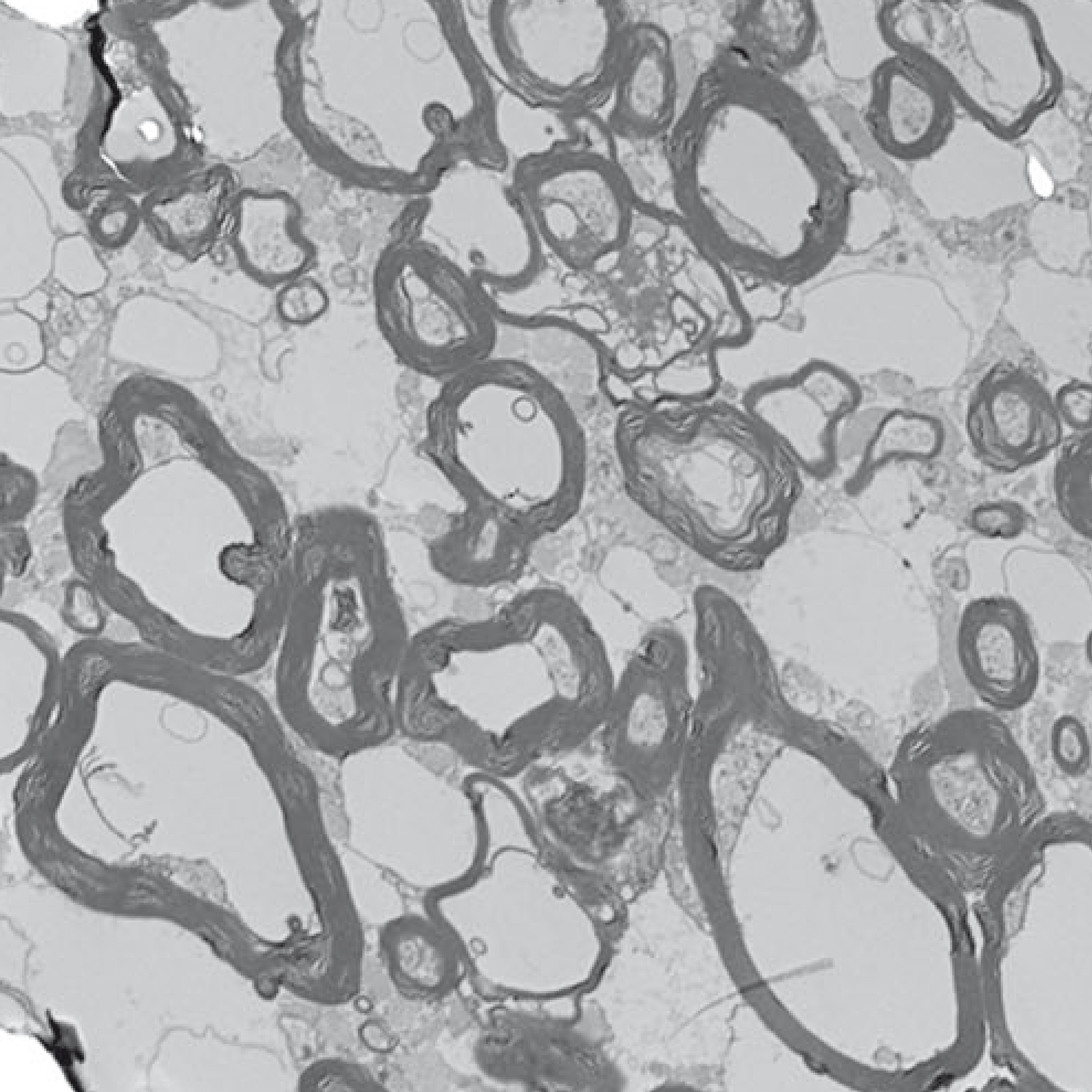Postmortem Assessment of Olfactory Tissue Degeneration and Microvasculopathy in Patients With COVID-19