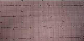 Podcast 694: Complete Heart Block