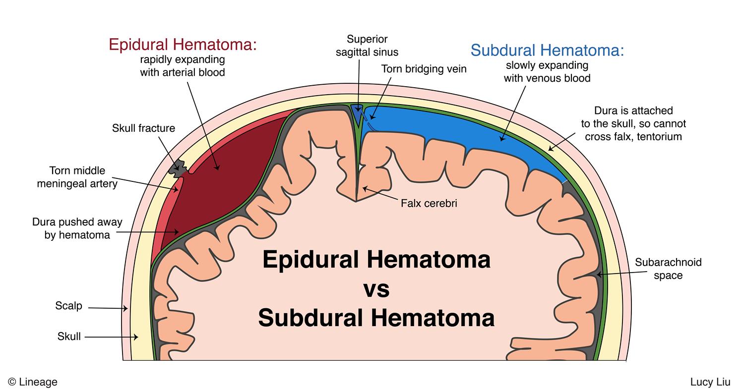 Podcast #278: Subdural Hematomas