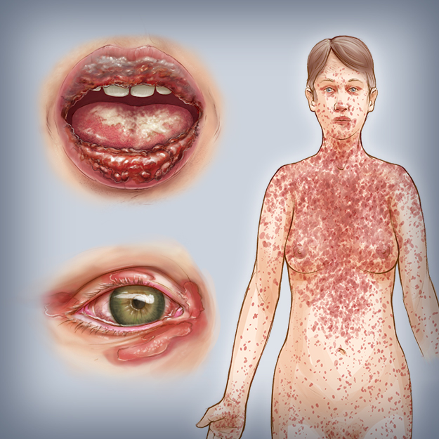 JAMA Dermatology Author Interviews
