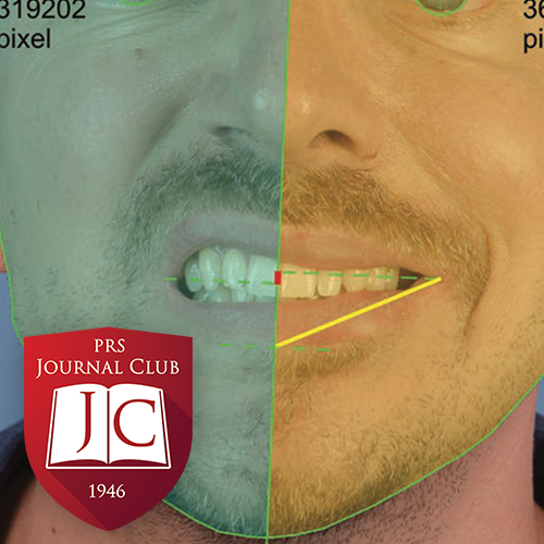 "Flap Debulking after Facial Reanimation" with Shai Rozen, MD - Jan. 2026 Journal Club "Flap Debulking after Facial Reanimation" with Shai Rozen, MD - Jan. 2026 Journal Club