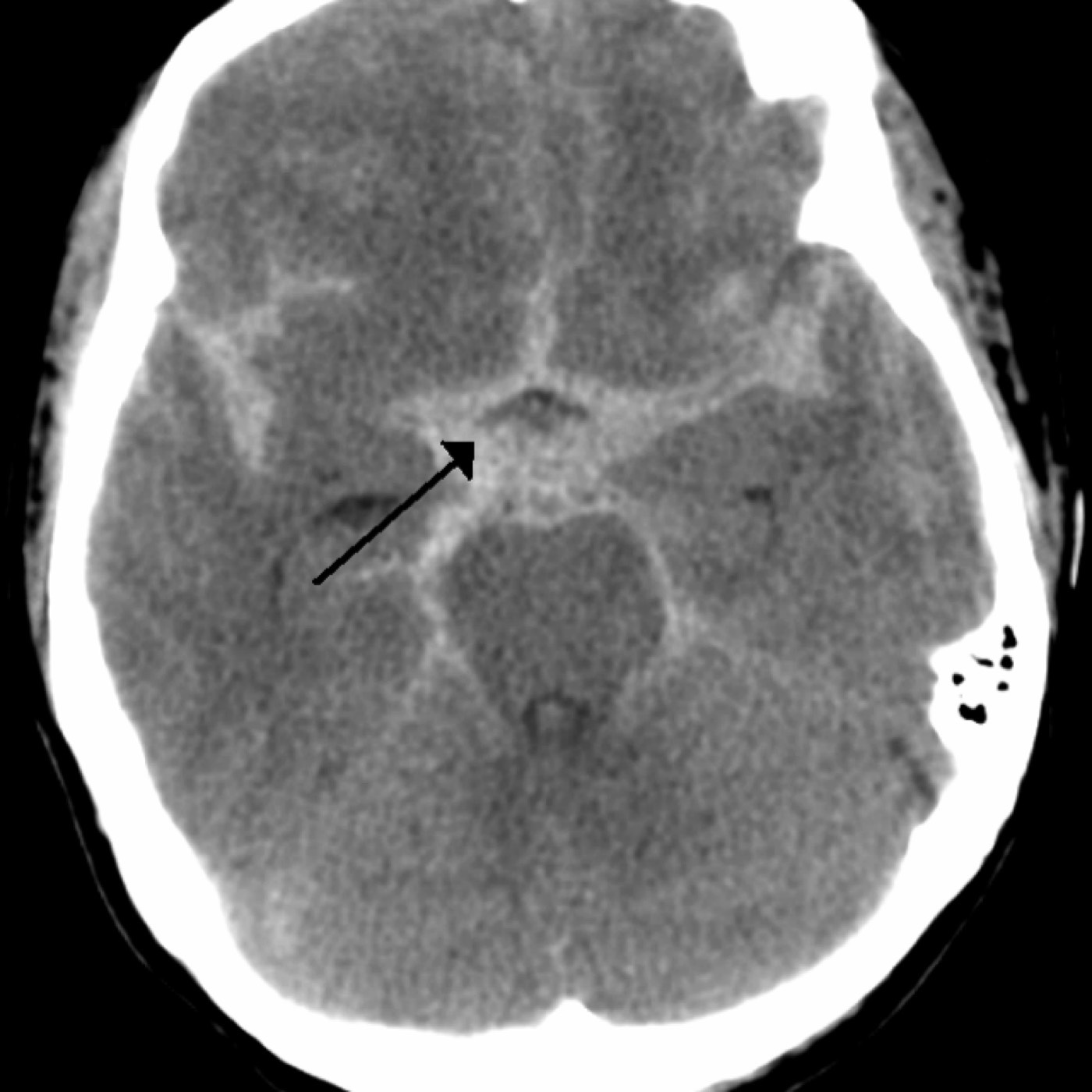 Subarachnoid Hemorrhage