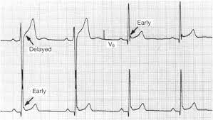 Podcast 846: Early Repolarization vs. Anterior STEMI