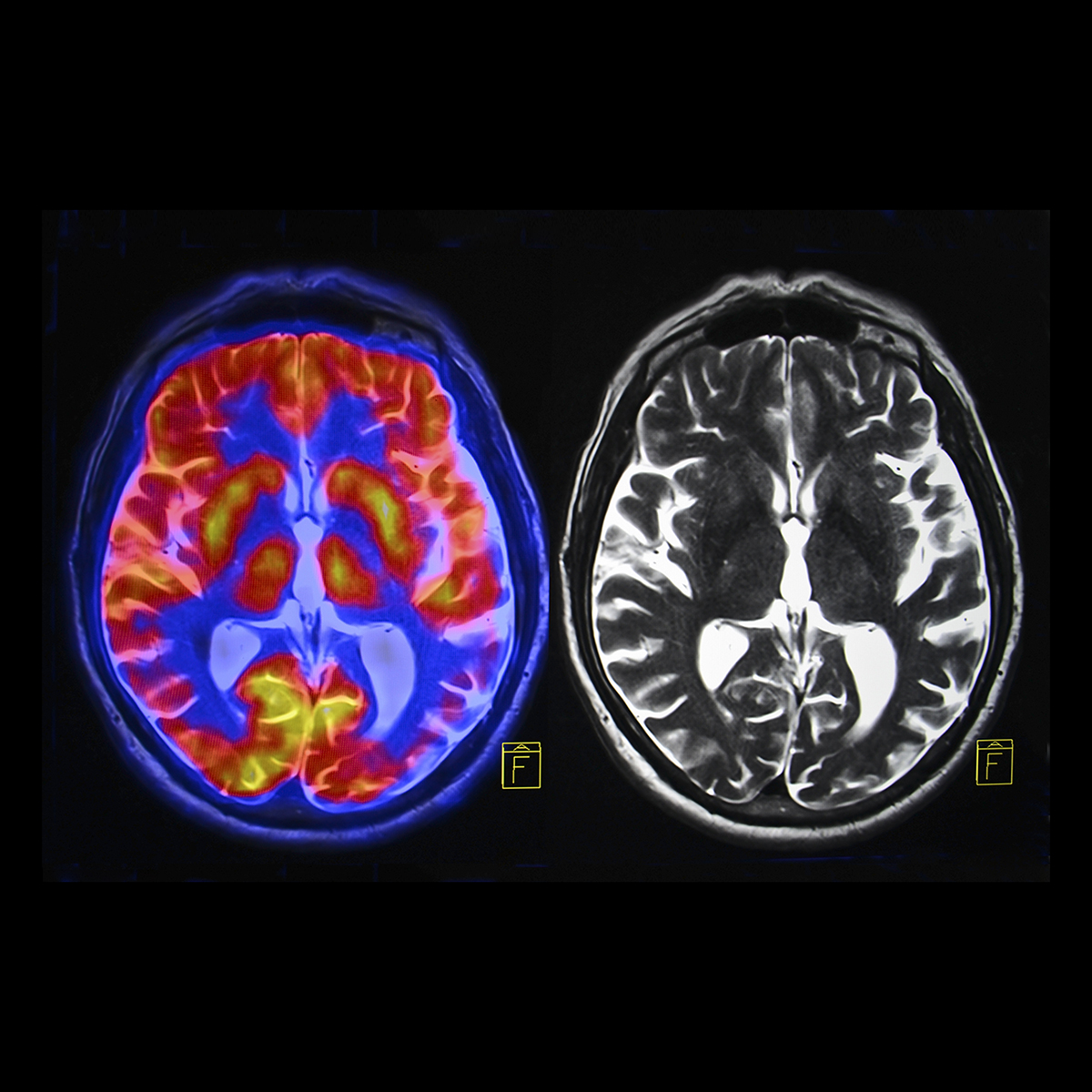 Ep. 50 - The Neuroscience of Psychopaths