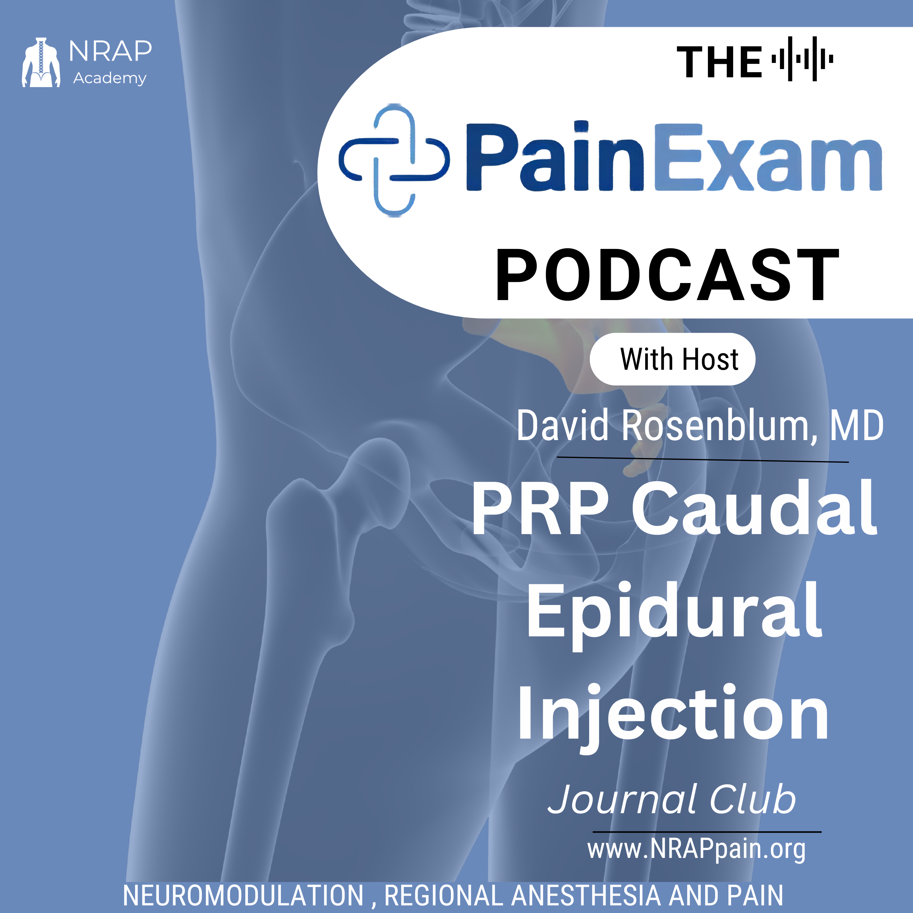 Caudal Epidural Steroid Injeciton with PRP