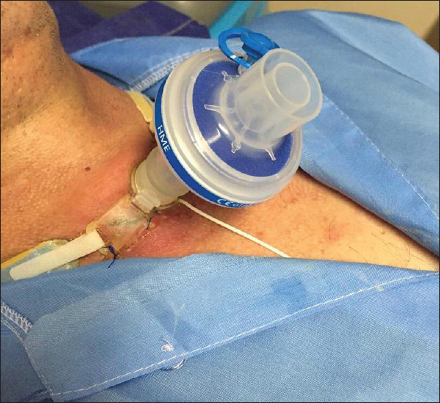 Podcast 788: Tracheostomy Bleeding