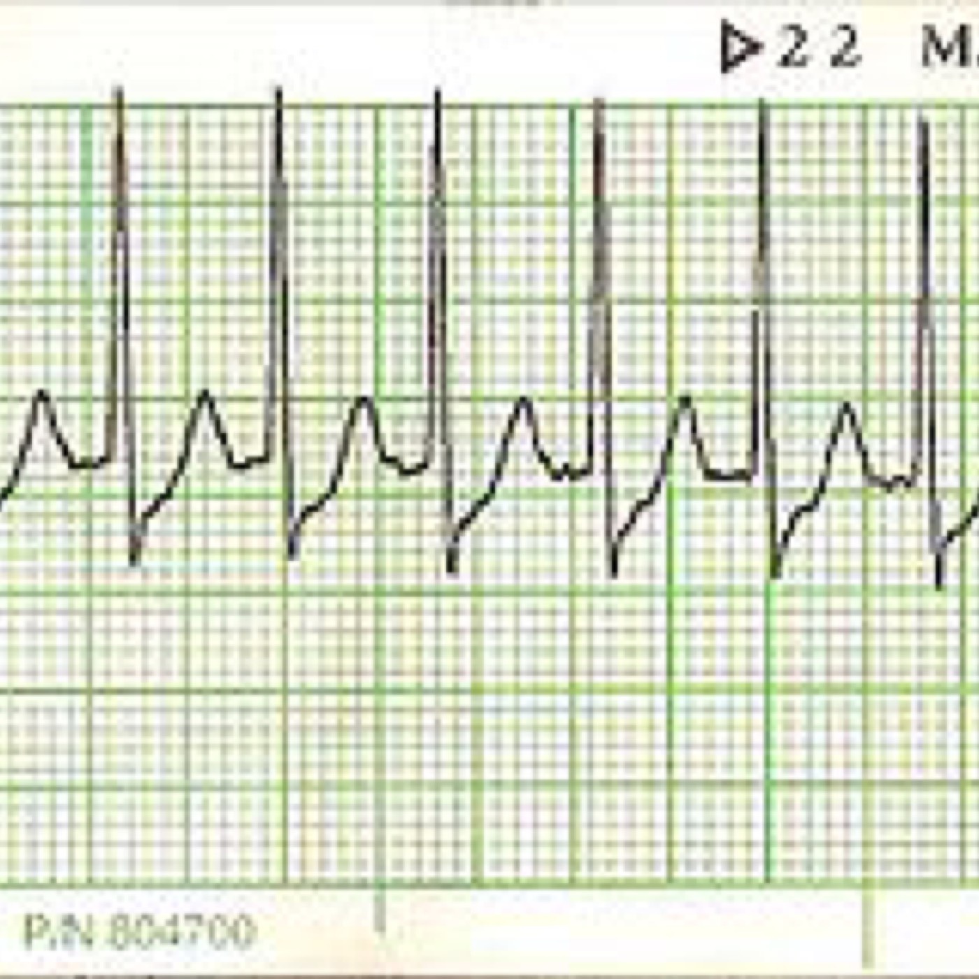Supraventricular Tachycardia