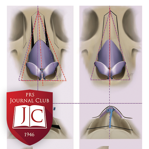 "External Strip and Internal Spreader Graft" with Gabriel Del Corral, MD - Nov. 2025 Journal Club