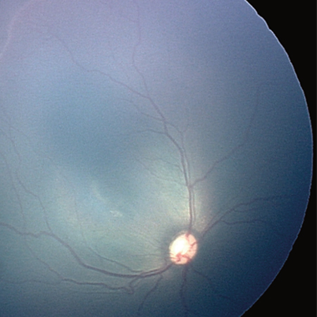 JAMA Ophthalmology Author Interviews