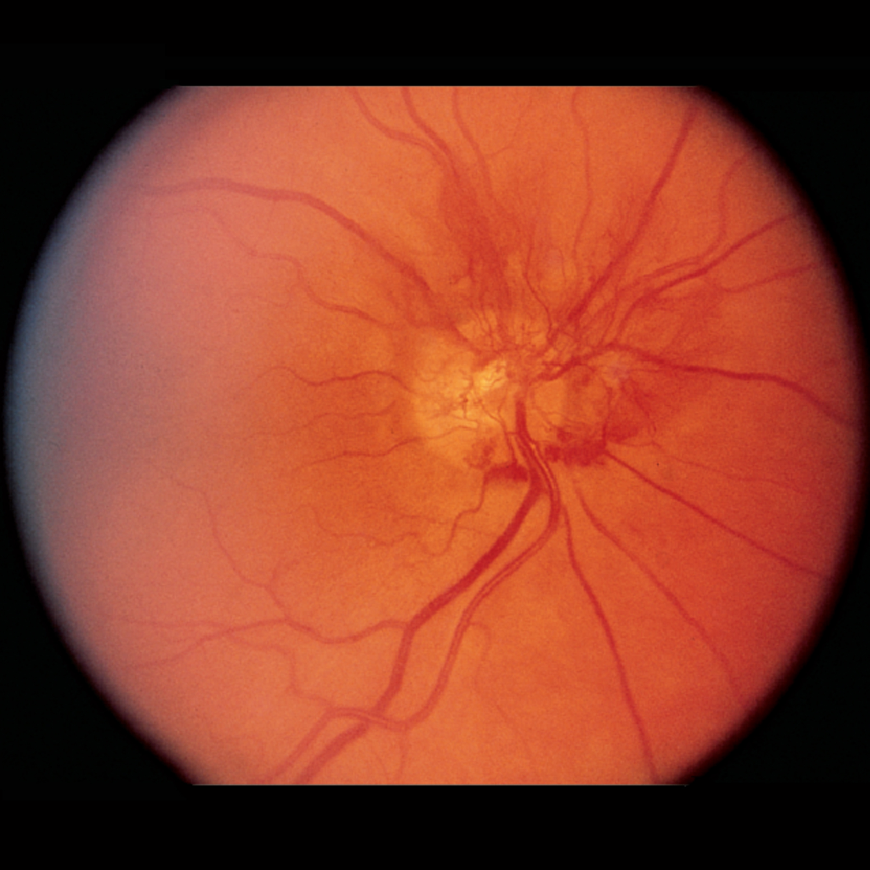 JAMA Ophthalmology Author Interviews