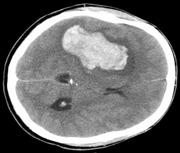 Podcast #291: Cincinnati Stroke Scale