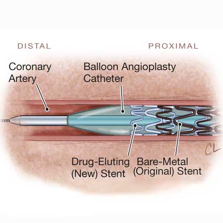 JAMA Cardiology Author Interviews