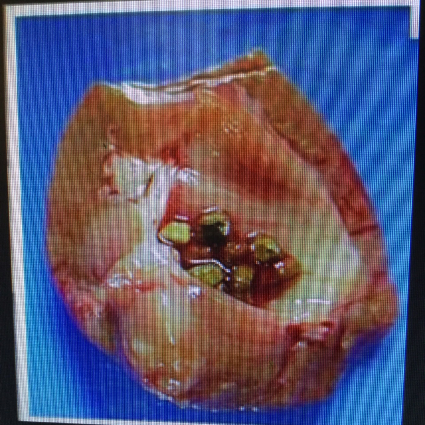 Flomax and Kidney Stones