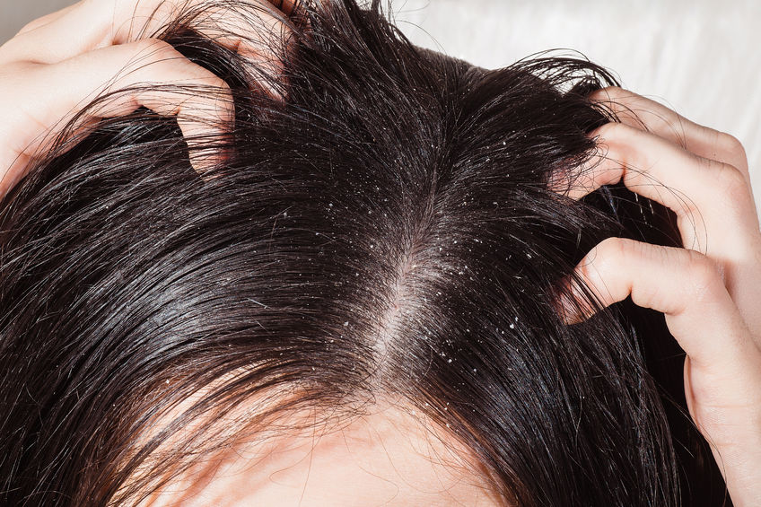 Top Causes & Tips to Prevent Dandruff & Dry Scalp