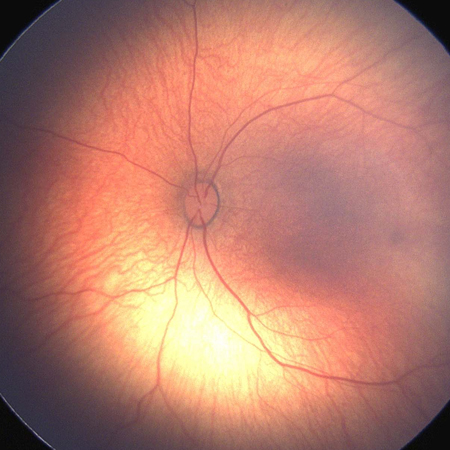 JAMA Ophthalmology Author Interviews