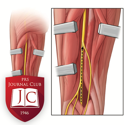 "Extended Sural Nerve Harvest" with Shai Rozen, MD - Jan. 2026 Journal Club
