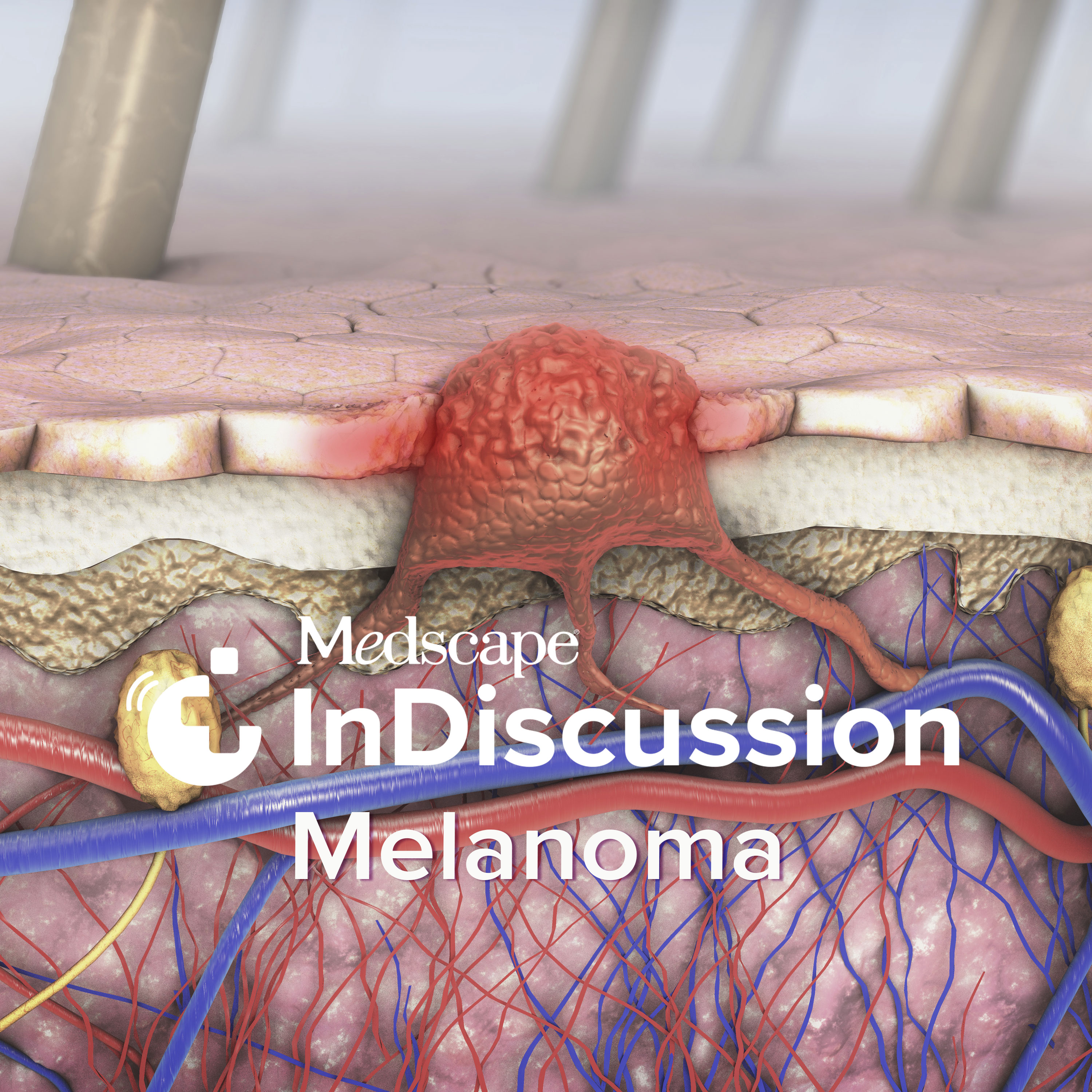 Medscape InDiscussion: Melanoma