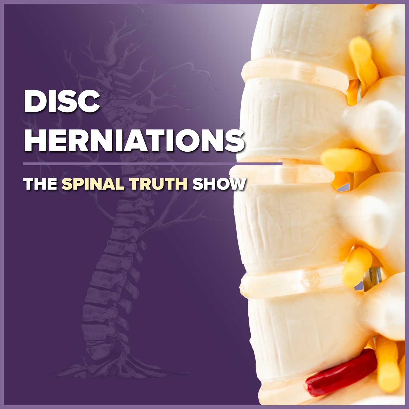 Disc Herniations