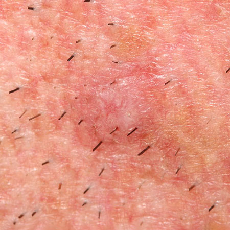 JAMA Dermatology Author Interviews