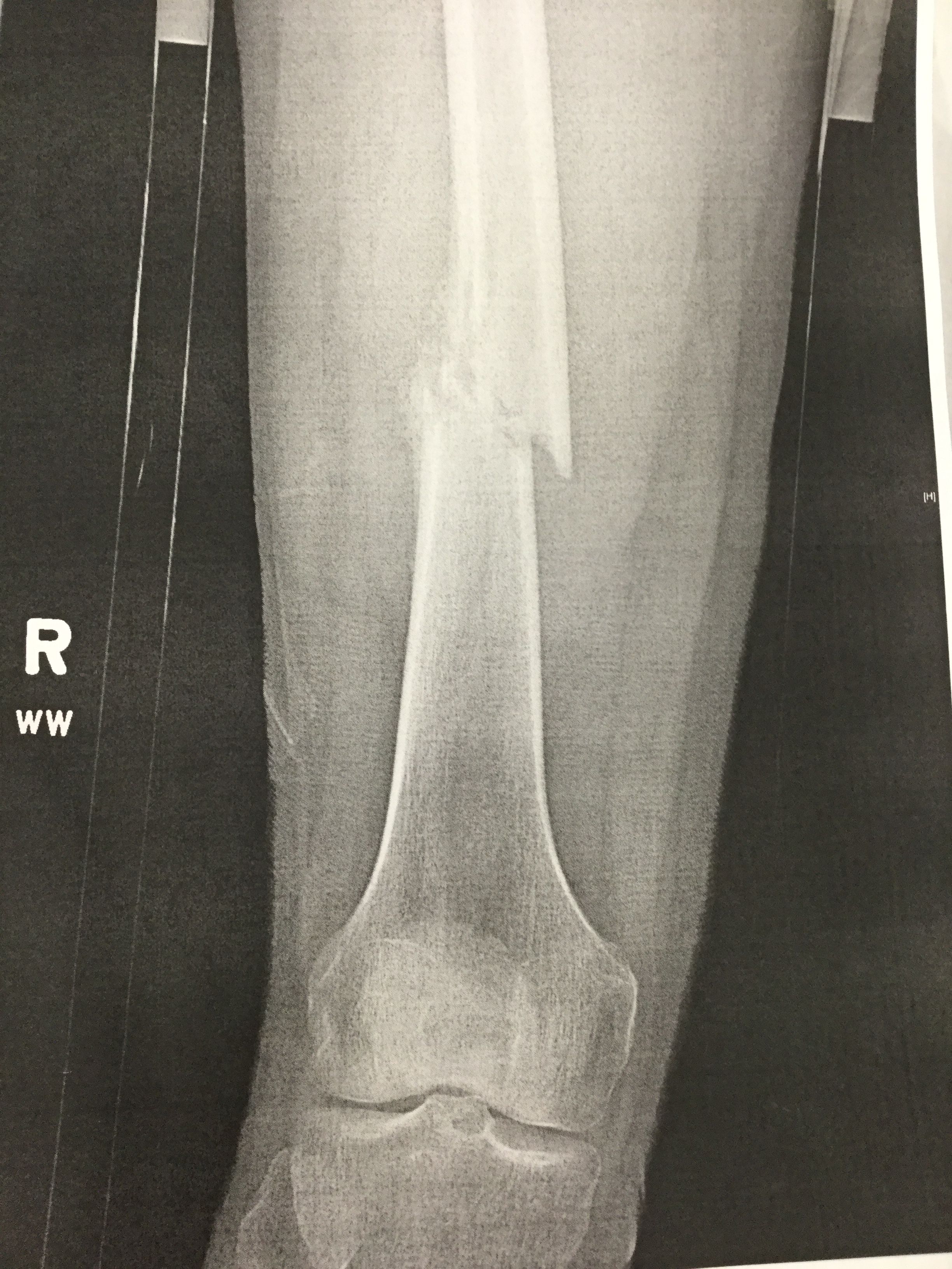Podcast 633: Pathologic Femur Fractures