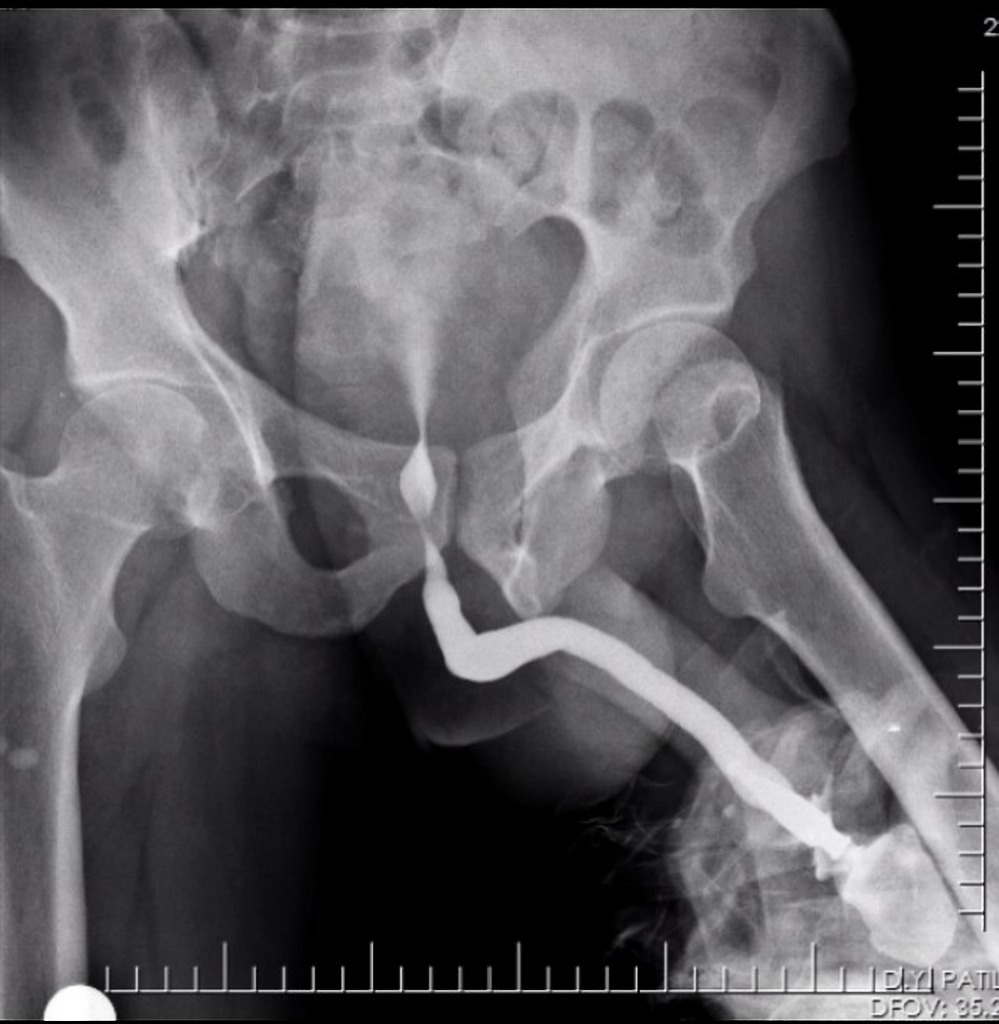 Podcast #206: Urethral Injuries