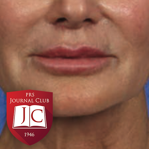 "Model for Lip Lift Counseling" with Lara Devgan, MD, MPH - Jul. 2025 Journal Club