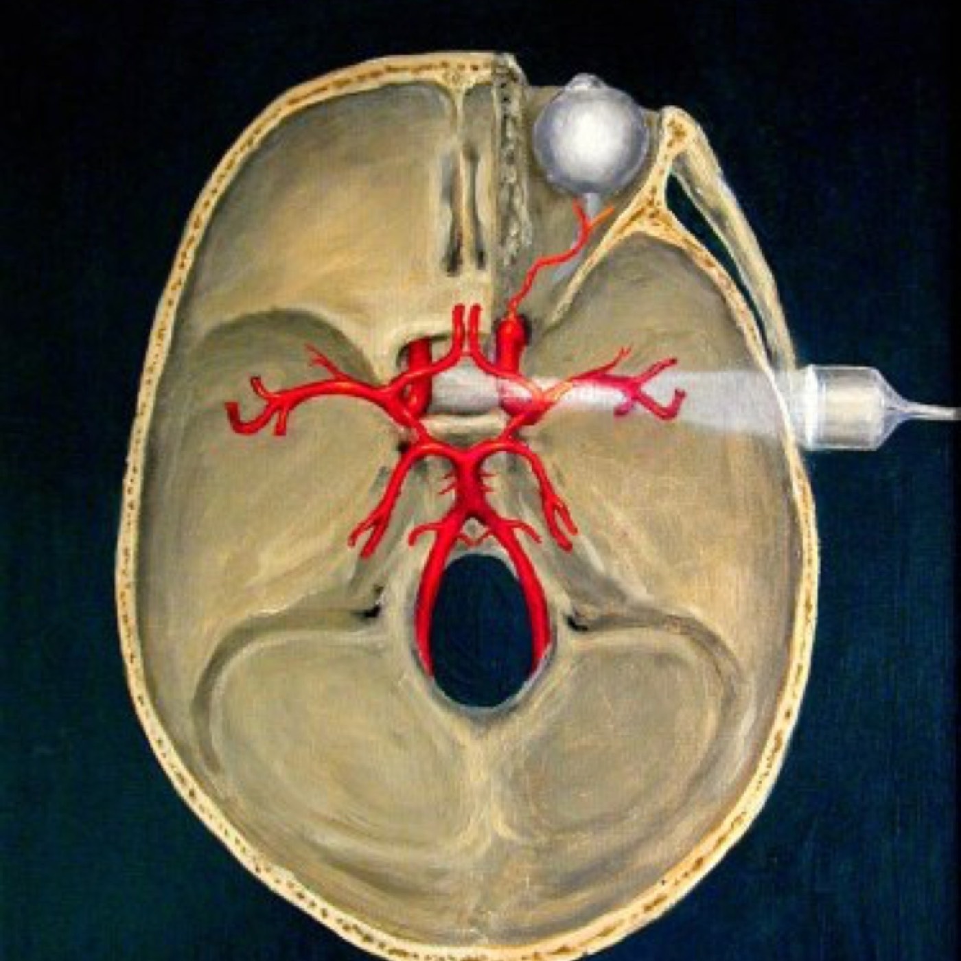 Transcranial Doppler in Concussion