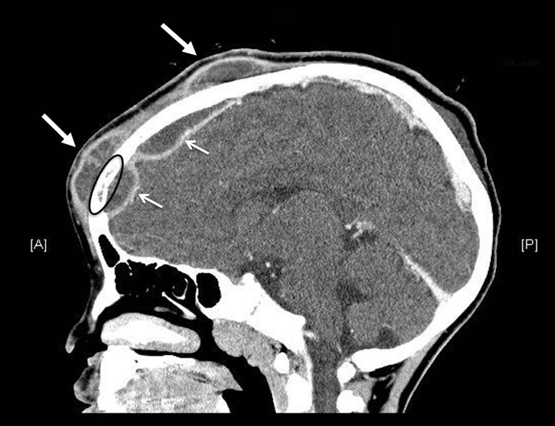 Podcast #242: Pott's Puffy Tumor