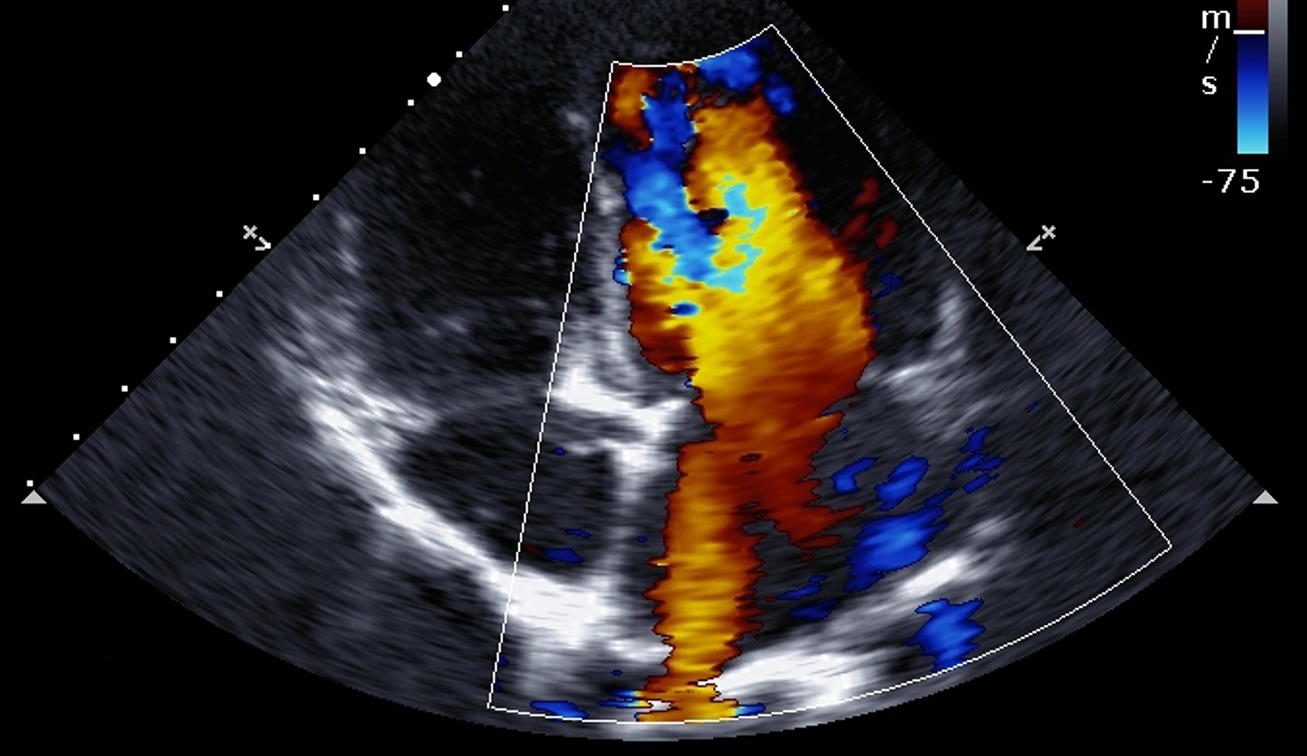 Podcast #238: Ultrasound in Cardiac Arrest